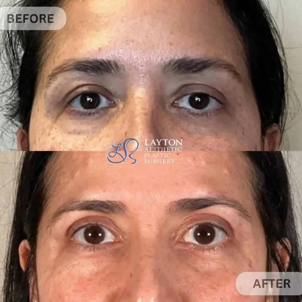 Blepharoplasty Upper eyelid | Layton Aesthetic plastic surgery