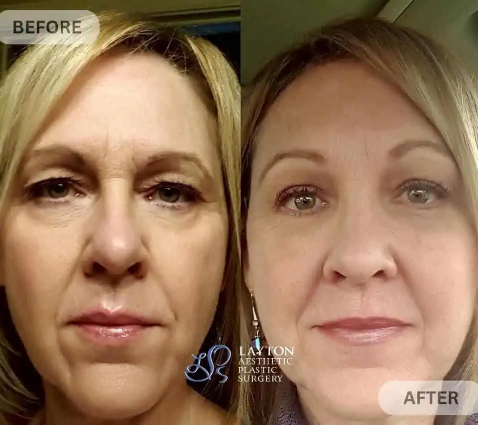 Blepharoplasty Upper eyelid | Layton Aesthetic plastic surgery