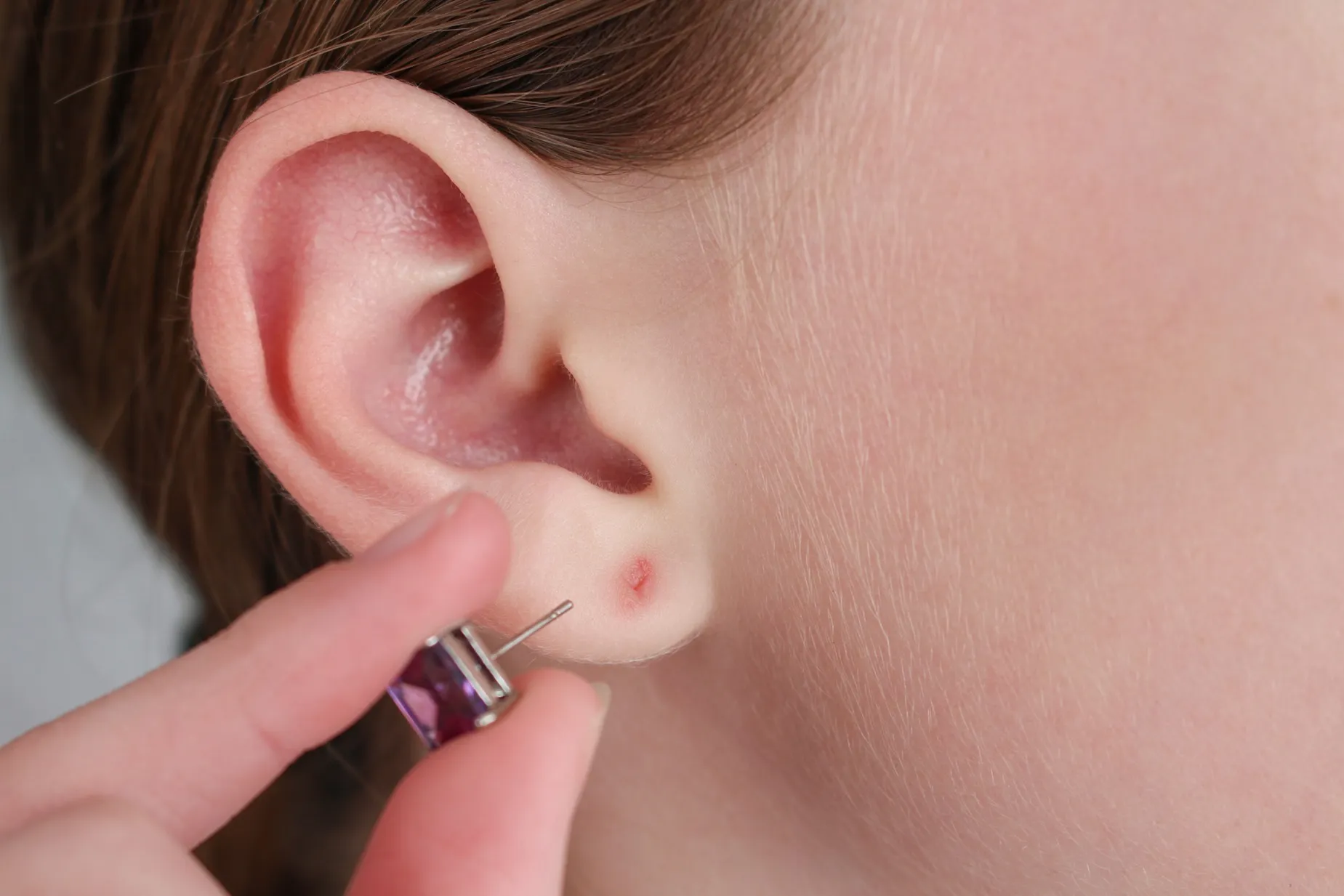 Earlobe Repair in Kerrville and Houston, TX | Layton Aesthetic plastic surgery