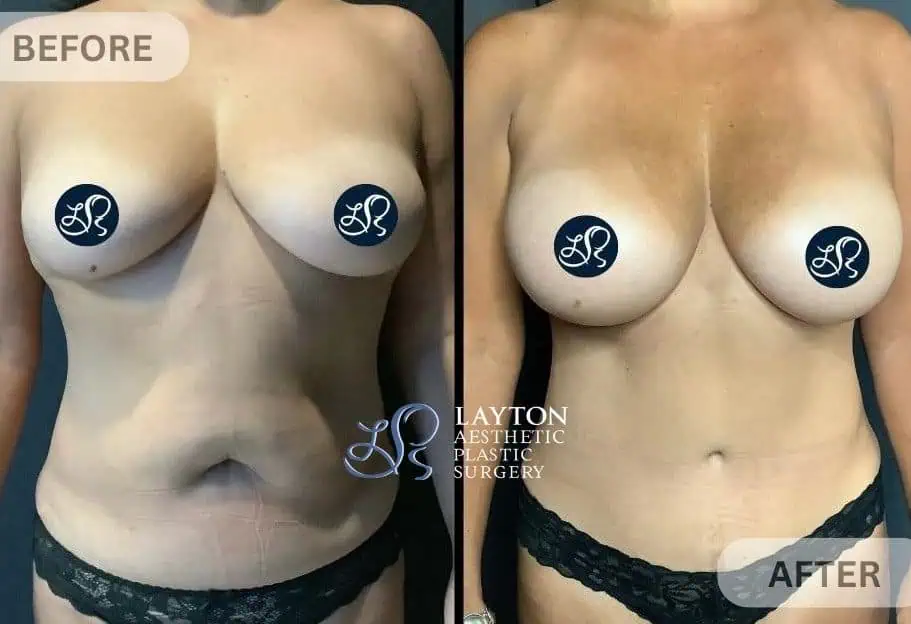 Breast Treatment at Layton Aesthetic plastic surgery