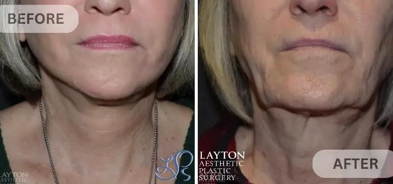 Lower Facelift at Layton Aesthetic plastic surgery