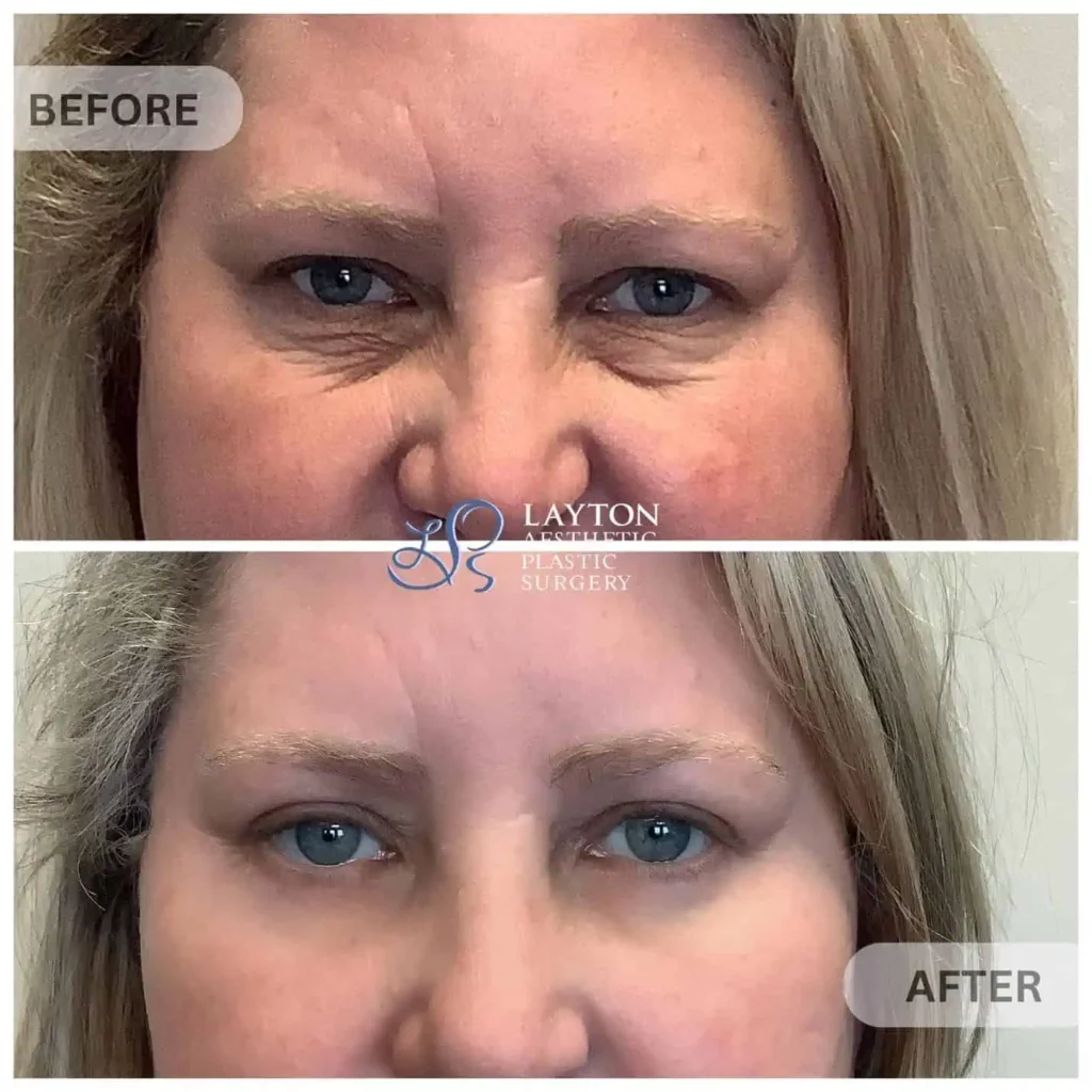 Lower Blepharoplasty at Layton Aesthetic plastic surgery