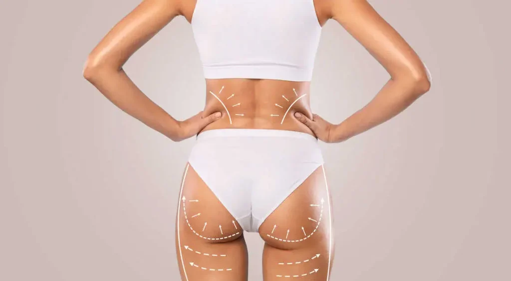 Brazilian Butt Lift in Kerrville and Houston, TX by Layton Aesthetic plastic surgery