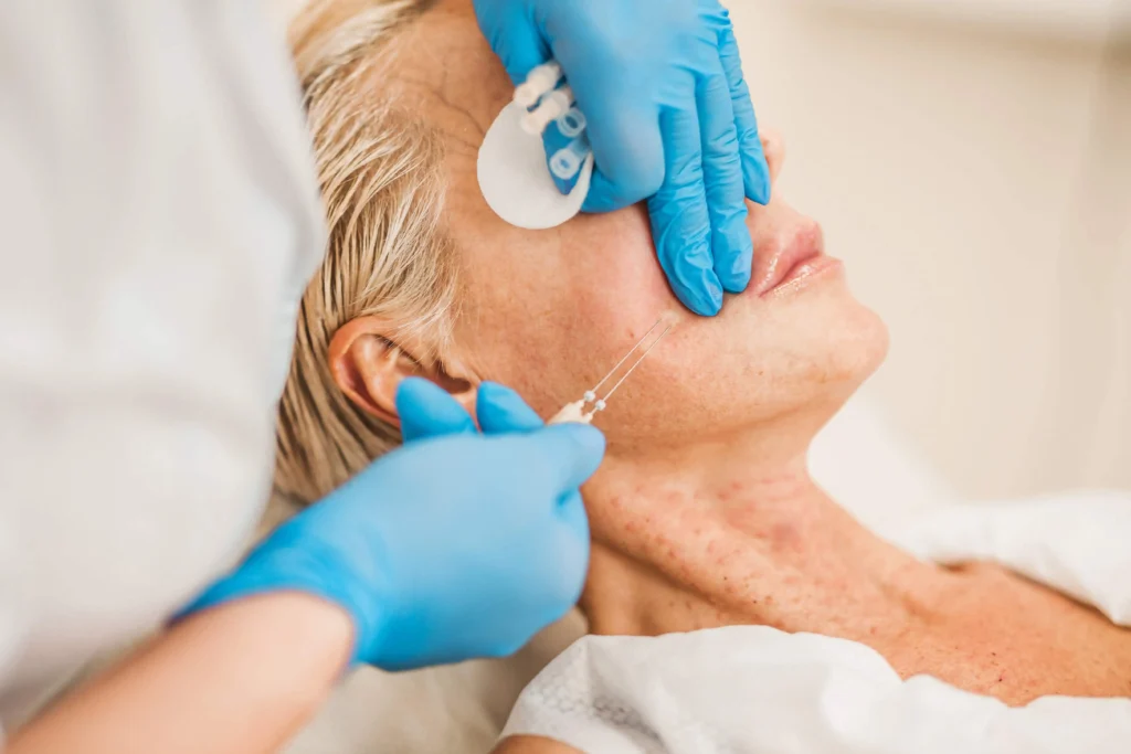 What Are PDO Threads? Complete Guide to Non-Surgical Lifting
