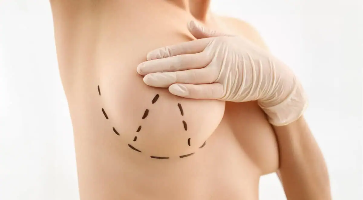 Pre-surgical markings before breast implant removal surgery at Layton Aesthetic Plastic Surgery in Houston, TX