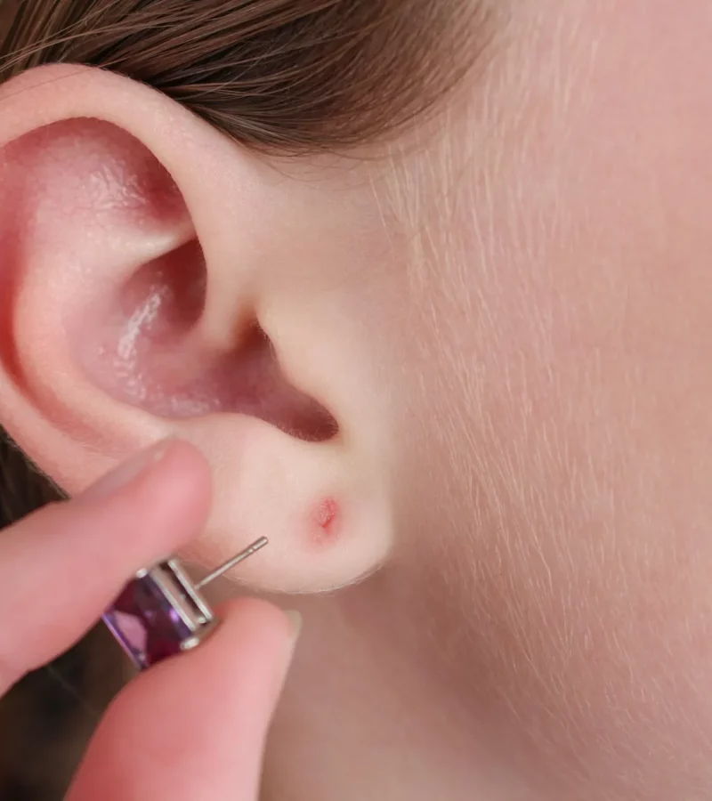 Earlobe Repair in Kerrville and Houston, TX | Layton Aesthetic plastic surgery