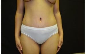 after Tummy Tuck front view