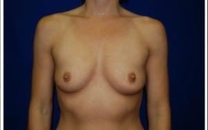 before Breast Augmentation front view