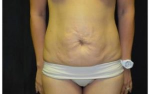 before Tummy Tuck front view